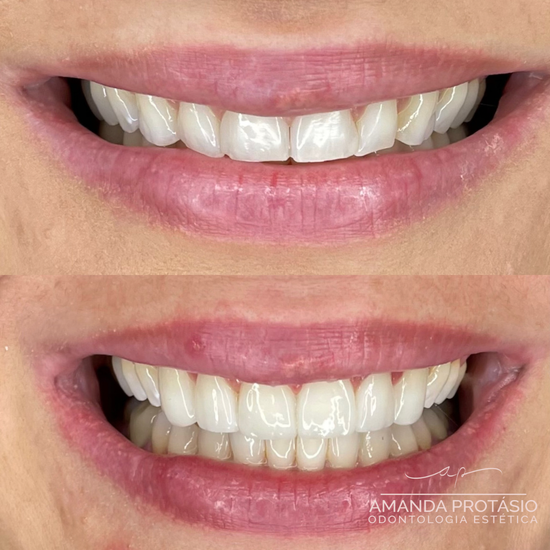 Comparativo de dois registros do mesmo sorriso, mostrando alinhamento e brilho naturais